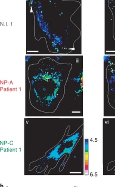 Lysosomes in fibroblasts from a healthy individual and two Niemann-Pick patients